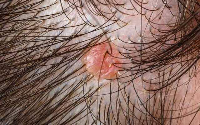 8 Types Of Scalp Folliculitis & Ways To Get Rid Of Them