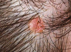 8 Types Of Scalp Folliculitis & Ways To Get Rid Of Them