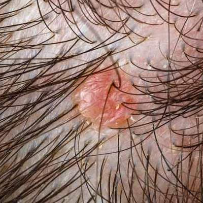 8 Types Of Scalp Folliculitis & Ways To Get Rid Of Them