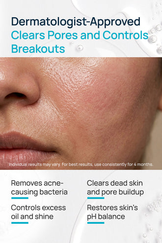 Acne-Limit Facial Toner With 0.1% Cucumber Extract & 0.1% Tea Tree Extract