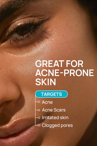 Acne Limit Combo With 9% Azelaic Acid and 0.1% Neem For Normal Skin