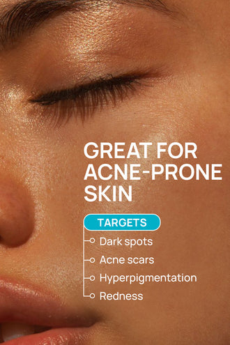Acne Limit Combo With 9% Azelaic Acid and 0.1% Aloe Vera For Dry Skin