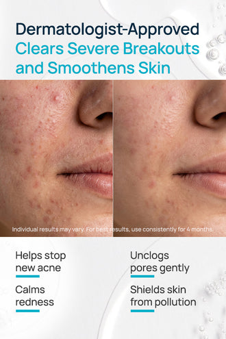 Acne Exfoliating Facial Cream With 5% Azelaic Acid & 5% Niacinamide