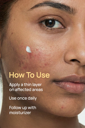 Acne-Limit Facial Cream With 9% Azelaic Acid & 4% Niacinamide