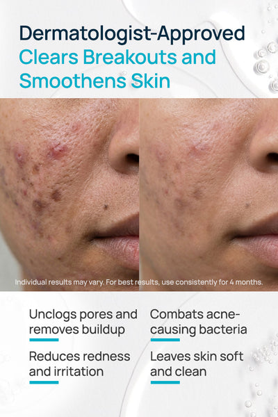 Salicylic Acid And Niacinamide Anti-Acne Face Mask