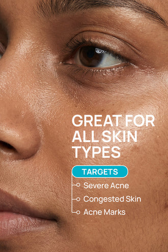 AcneShield Combo With  5% Azelaic Acid and 0.8% Tea Tree Oil For All Skin Types